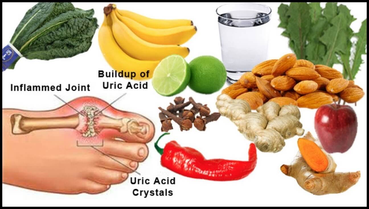 통풍의 원인&#44; 초기 증상&#44; 치료방법&#44; 좋은 음식&#44; 해로운 음식