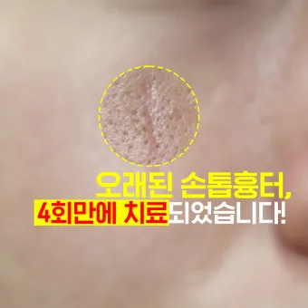 흉터전용 치료 추천 스카덤 겔 효능효과_16