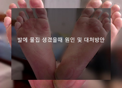 발에 물집 생겼을때 원인 및 대처방안