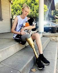 황금 보철물 모델 Lauren Bartha