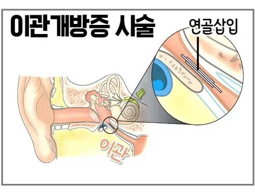 이관개방증-치료-시술