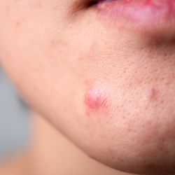 턱밑 여드름 치료 방법 사진-2