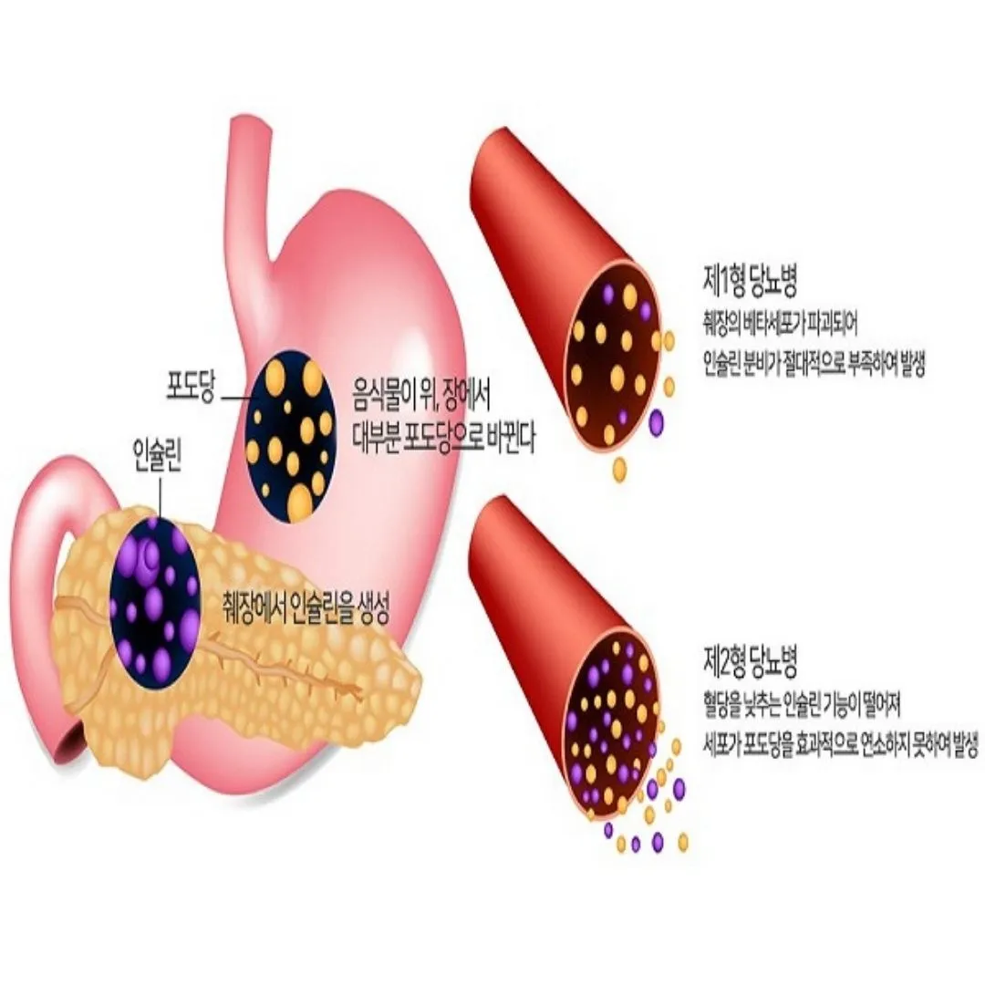 당뇨병 초기증상&amp;#44; 당뇨에 좋은음식