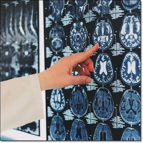 지아잔틴 효능 두뇌 건강&#44; 뇌 촬영 영상