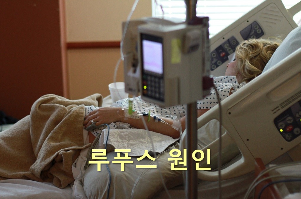 루푸스 원인과 루푸스 생존율