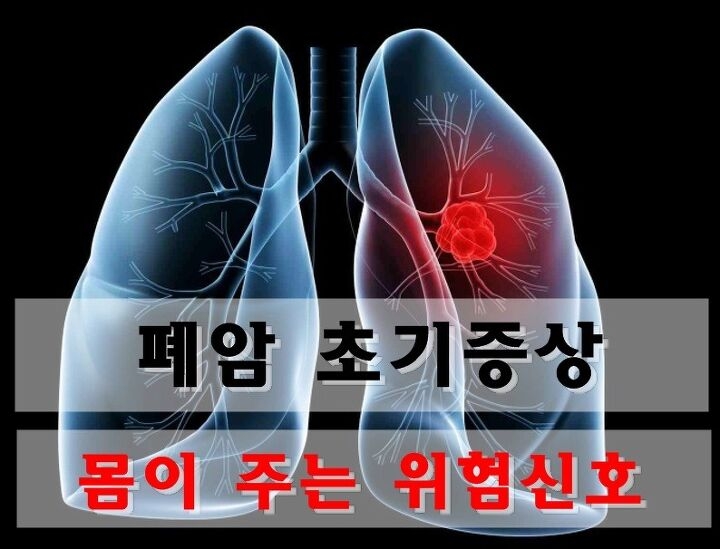 폐암 초기증상 원인 자가진단 정보 총정리4
