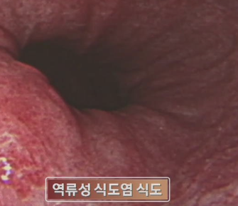 식도염 증상 12가지 총정리 섬네일