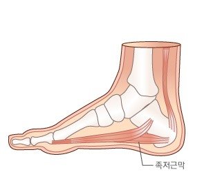 족저근막염