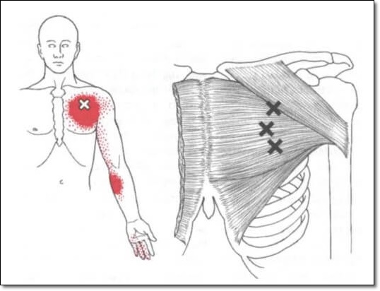 대흉근의 중부 섬유에 나타나는 통증유발점을 보여주는 그림
