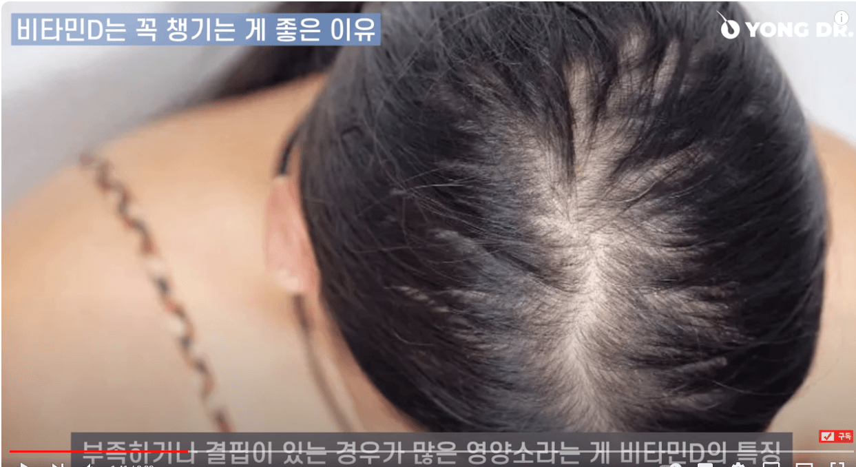 탈모에 