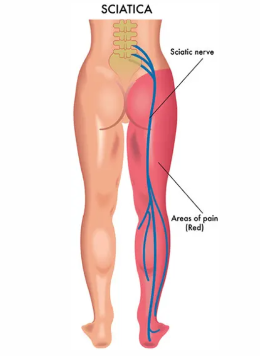 좌골신경통 영등포구 도수치료센터에서 시원하게 5