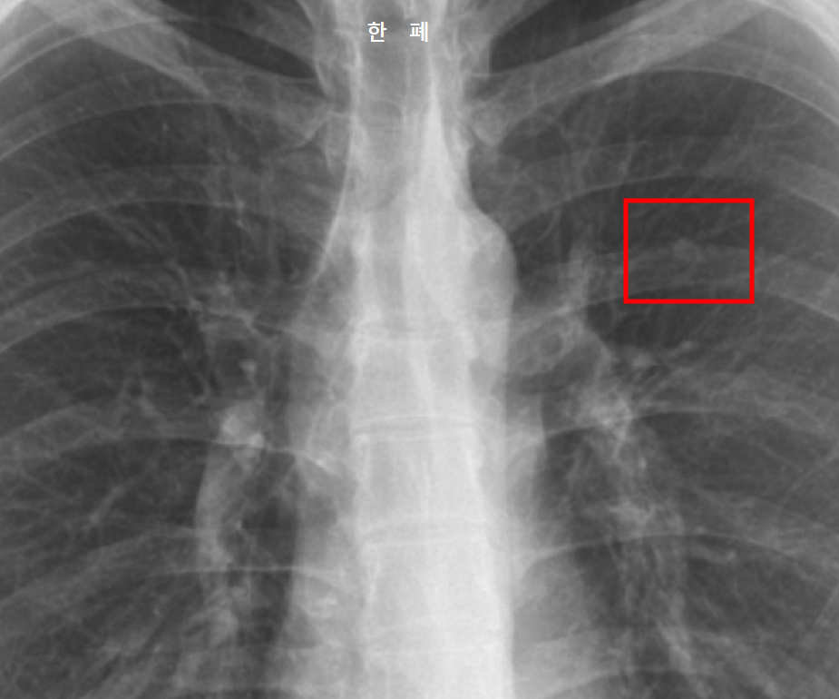 폐결절 X-ray 사진