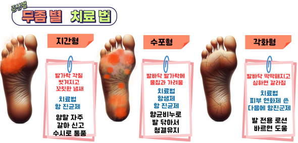 무좀별-치료법