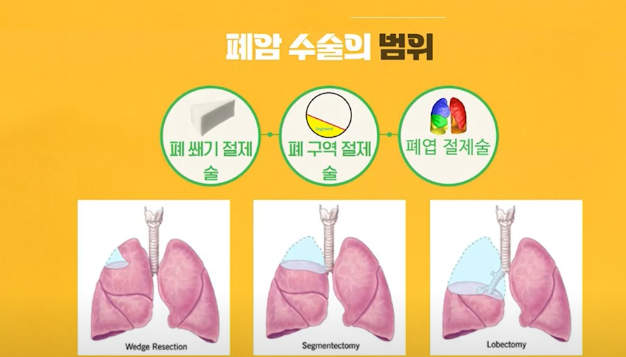 폐암 수술