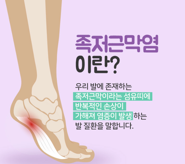  족저근막염의 원인, 증상, 치료 방법