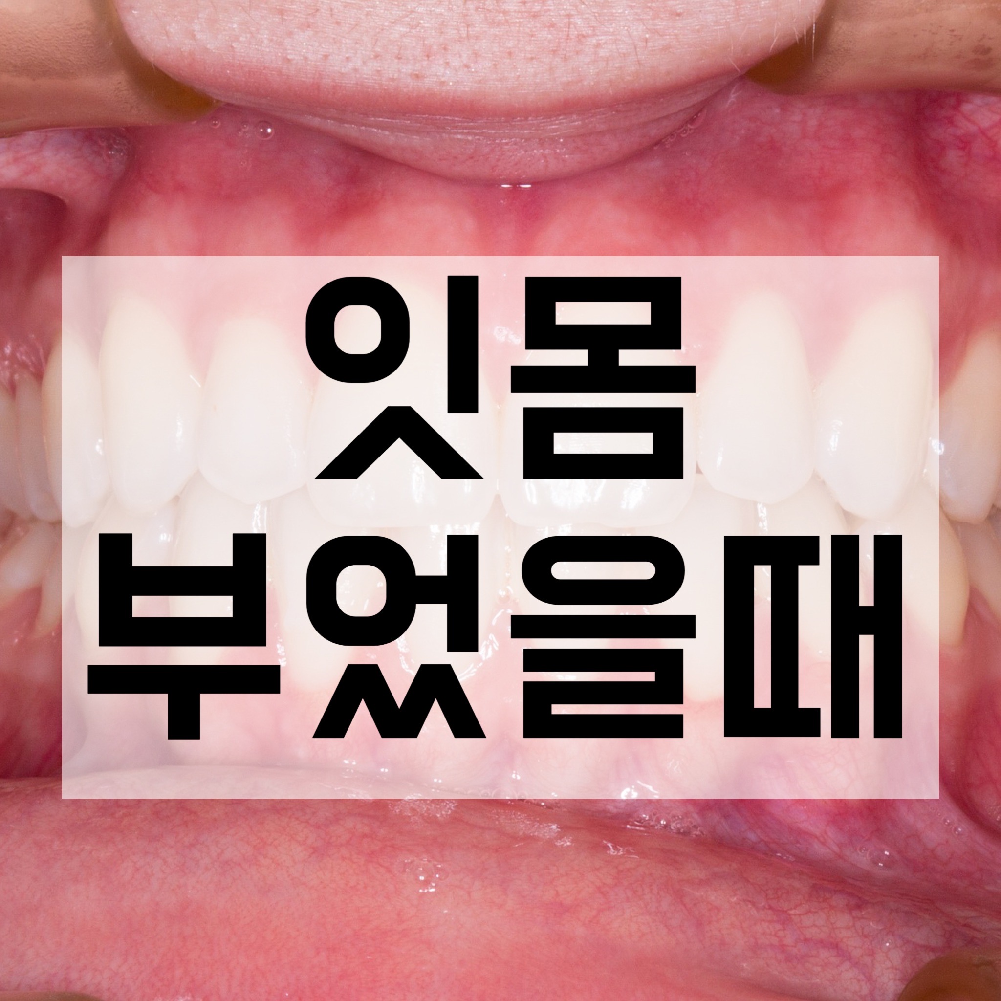  잇몸 부었을때