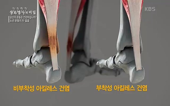 [821회] 생로병사의 비밀 - KBS821회] 생로병사의 비밀.ts_20220824_143649.444.jpg