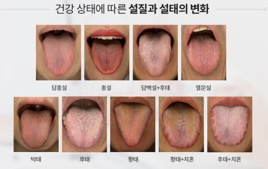 혀로 알아보는 내 몸 상태