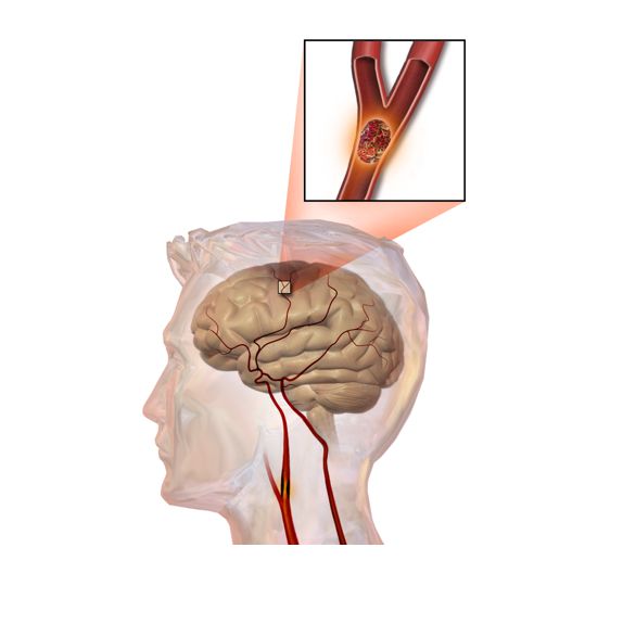 뇌졸중 발생 기전