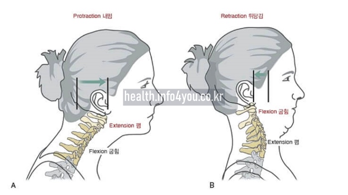 경추 추간판 탈출증에 좋은 운동 - 턱 당기기