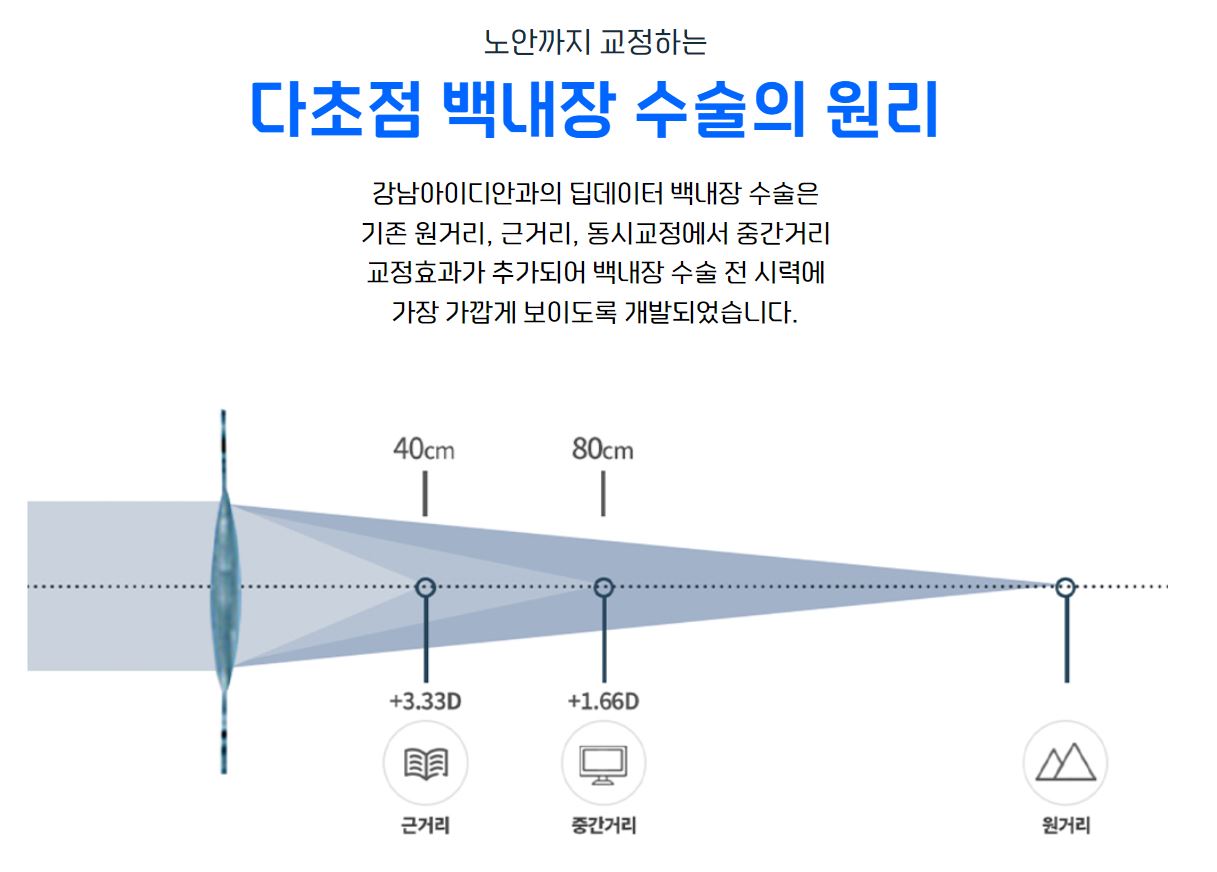 백내장수술의 원리