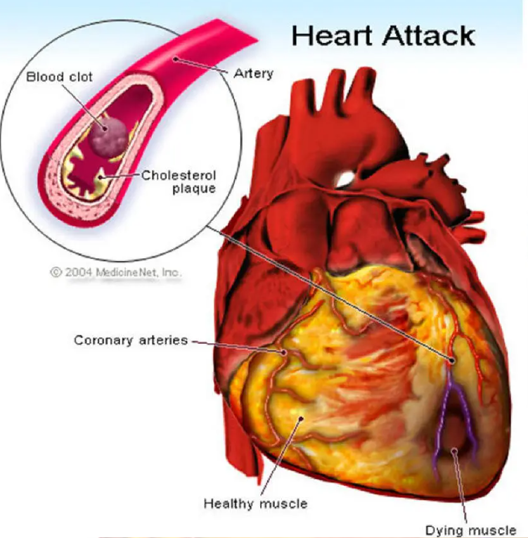 심장마비 Myocardiac infarction