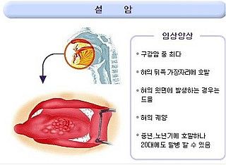 설암 증상, 원인, 치료, 예방 총정리