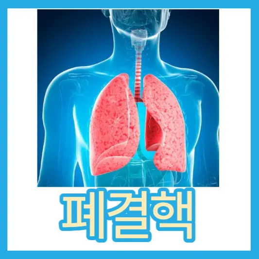 잠복결핵 폐결핵 초기증상 결핵 증상 전염 검사 치료 약