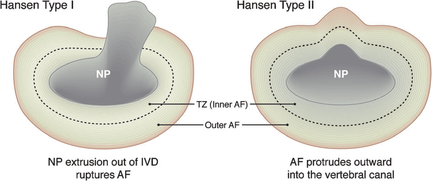 hansen type1-hansen type2