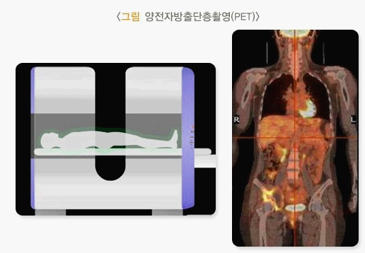 양전자방출단층촬영{PET)