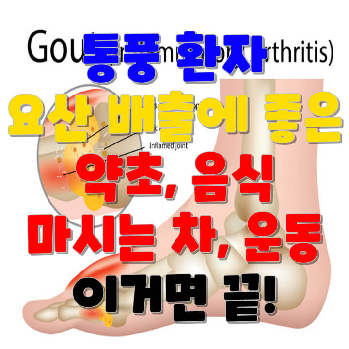 통풍 환자 요산 배출에 좋은 약초&#44; 음식&#44; 마시는 차&#44; 운동 이거면 끝!