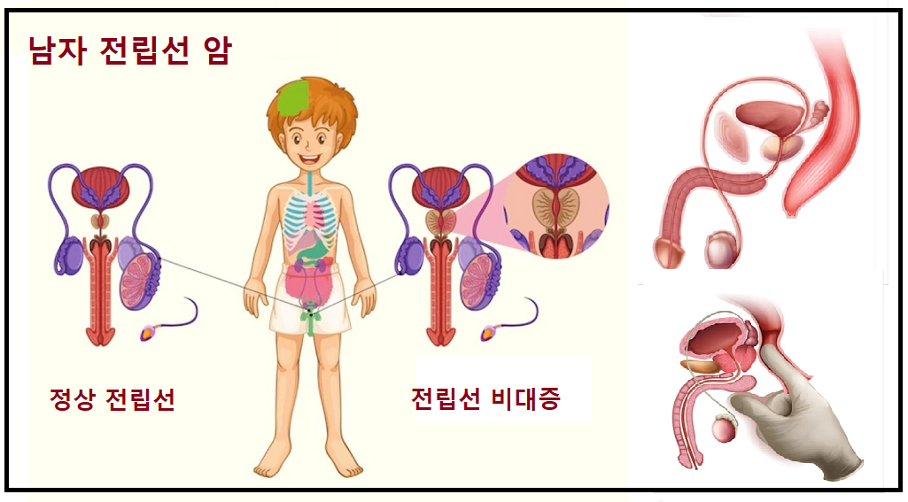  전립선 비대증 증상이란?, 전립선 비대증 치료란?.