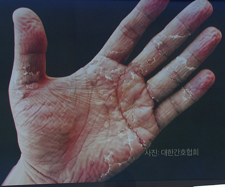  어느 간호사의 손