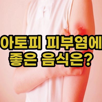  아토피 피부염에 좋은 음식