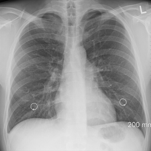 폐 x-ray 사진