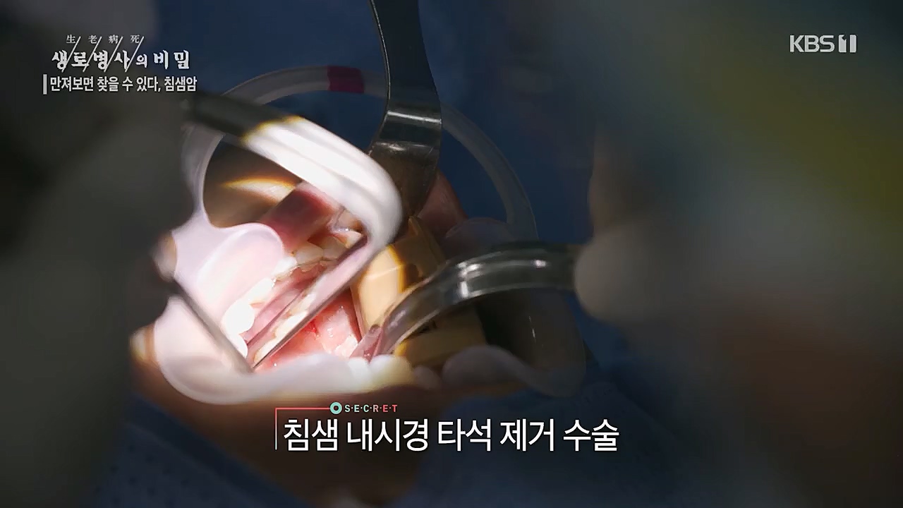 생로병사의 비밀.E851.230112p.H264-F1RST.mp4_20230119_200628.506.jpg