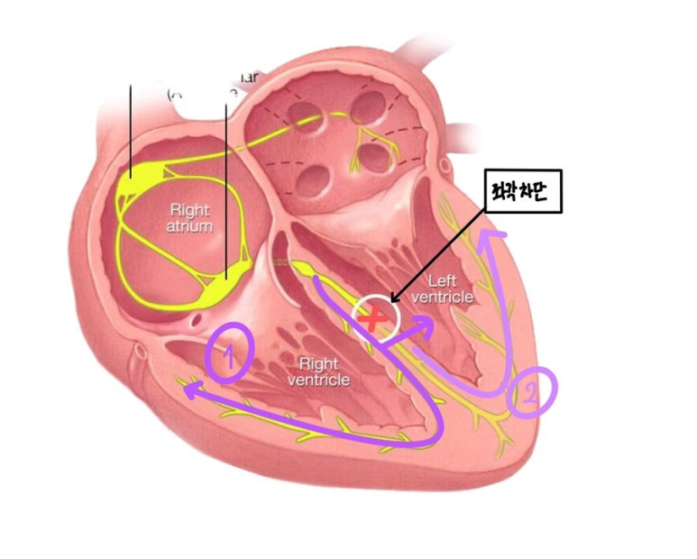 좌각차단에서 심장전기흐름