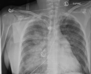 bilateral perihilar airspace opacity , interstital edema , Kerley B line