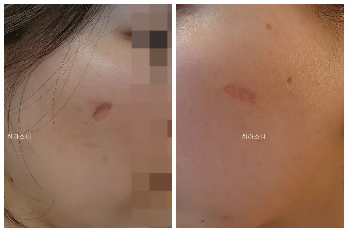 6월 30일의 흉터 모습. 딱지는 완전히 탈락되었고 붉은기는 조금 남아 있는 모습.