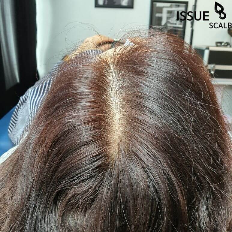  두피문신 여러 번 받는 이유는? [부천 청라 송도 구월동 부평 상동 중동 인천 두피문신]