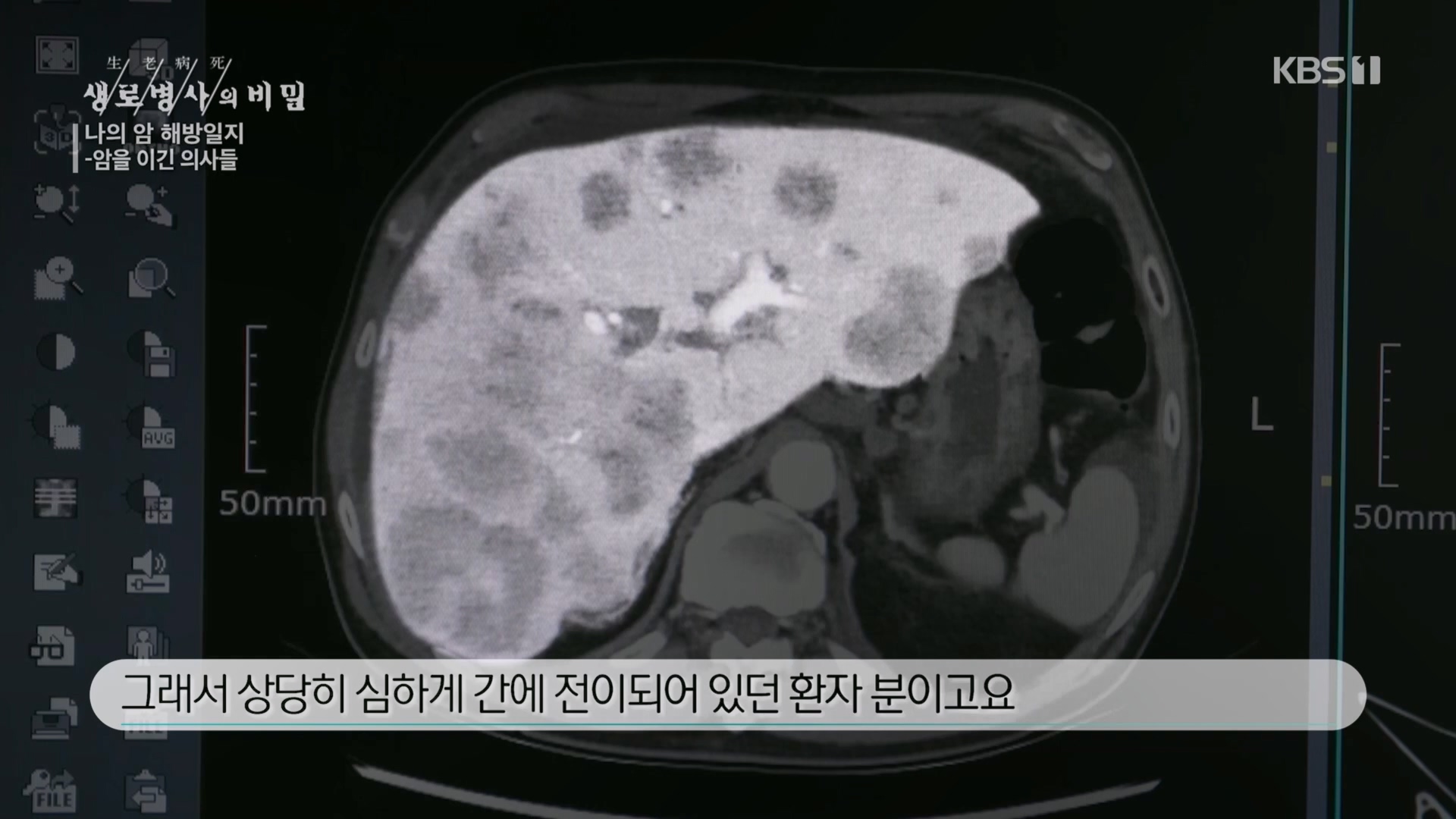 생로병사의 비밀.E889.231129p.H264-F1RST.mp4_20231130_204108.825.jpg