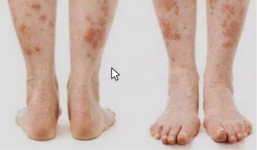  피부에 나타나는 증상으로 알아보는 당뇨병