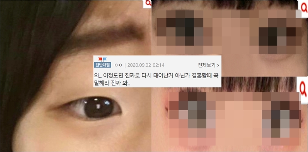 쌍수해도 답 없다는 꼬막눈 쌍수 후기 ㄷㄷ 쌍수해도 답 없다는 꼬막눈 쌍수 후기 ㄷㄷ