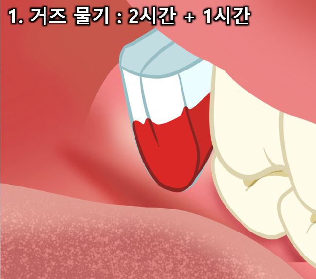 사랑니 발치 후 주의사항 치과의사가 완벽정리