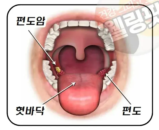 편도암은-혓바닥-안쪽의-편도에-발생한-악성-종양-입니다.