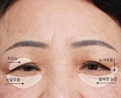 처진 눈꺼풀 수술, 처진눈 리프팅, 처진눈 올리기 방법, 비용, 주의사항