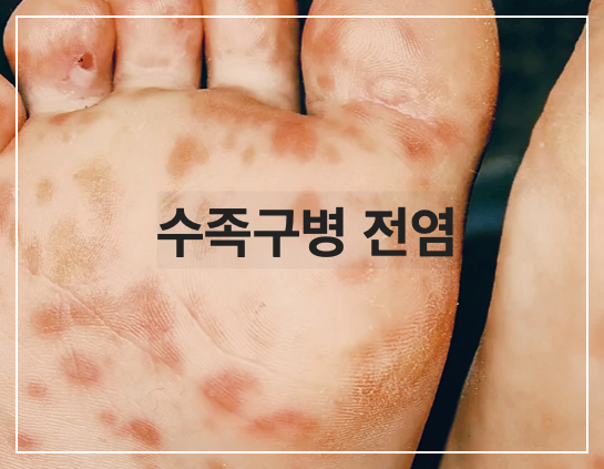 수족구병 전염성