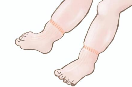 부은 발