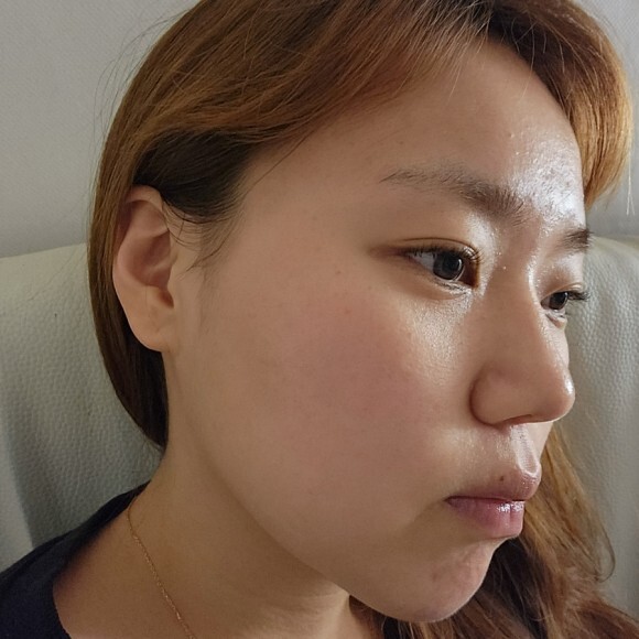  [3년만에 완전 바뀐 나의 여드름성 피부] PDT치료 후 바뀐 나의 피부 모습
