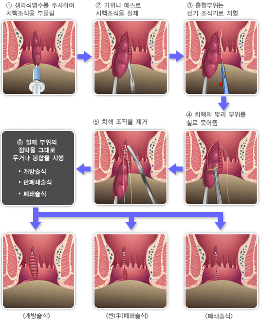 치질-수술-과정